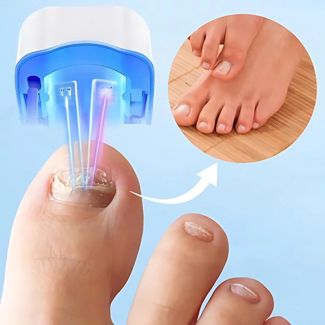 Pijnloze Infrarood Laserbehandeling voor Gezonde Nagels