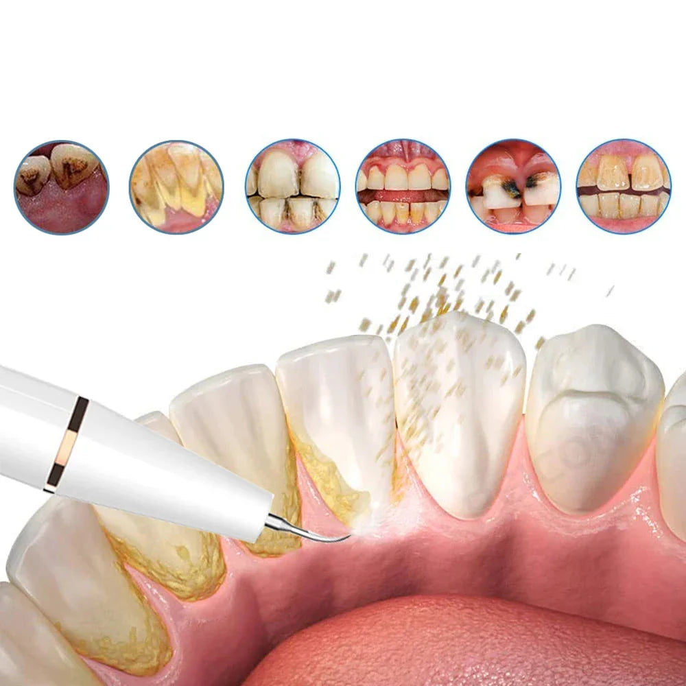 Ultrasone Tandsteenreiniger voor Effectieve Mondverzorging 1