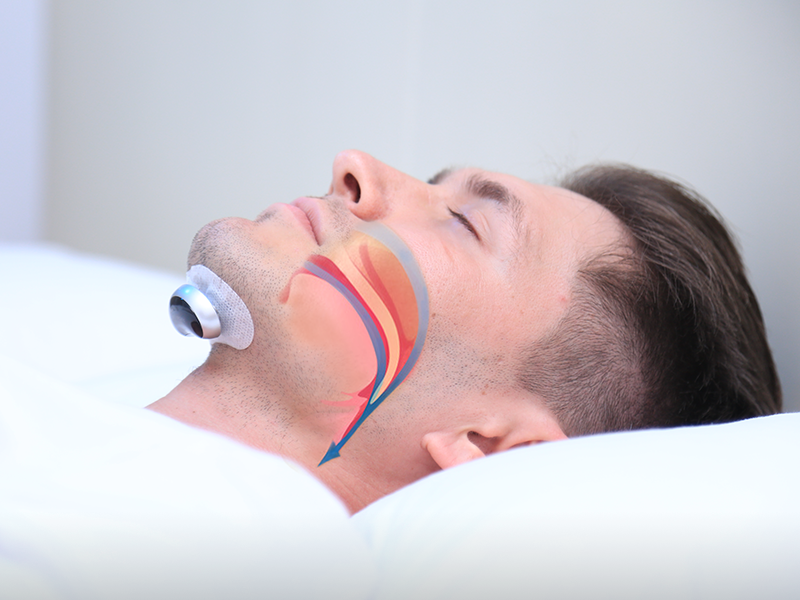 Effectieve Anti-Snurker voor Ononderbroken Slaap – Medisch Getest Device