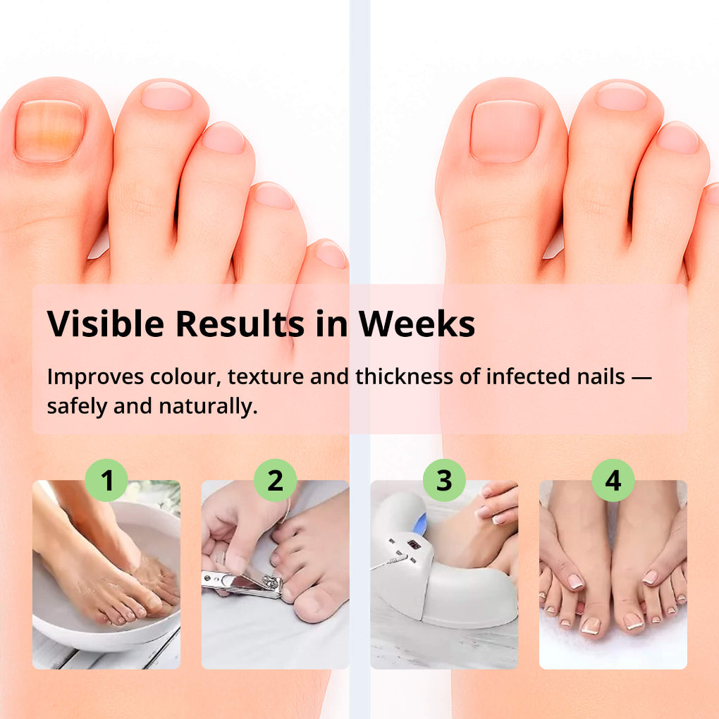 Effectieve Lichttherapie voor Gezonde Nagels – Draagbaar Apparaat