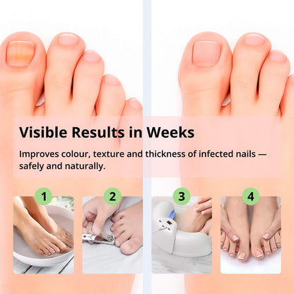 Effectieve Lichttherapie voor Gezonde Nagels – Draagbaar Apparaat