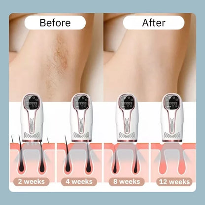 IPL Laser Ontharingsapparaat – Pijnloze Body & Facial Hair Removal